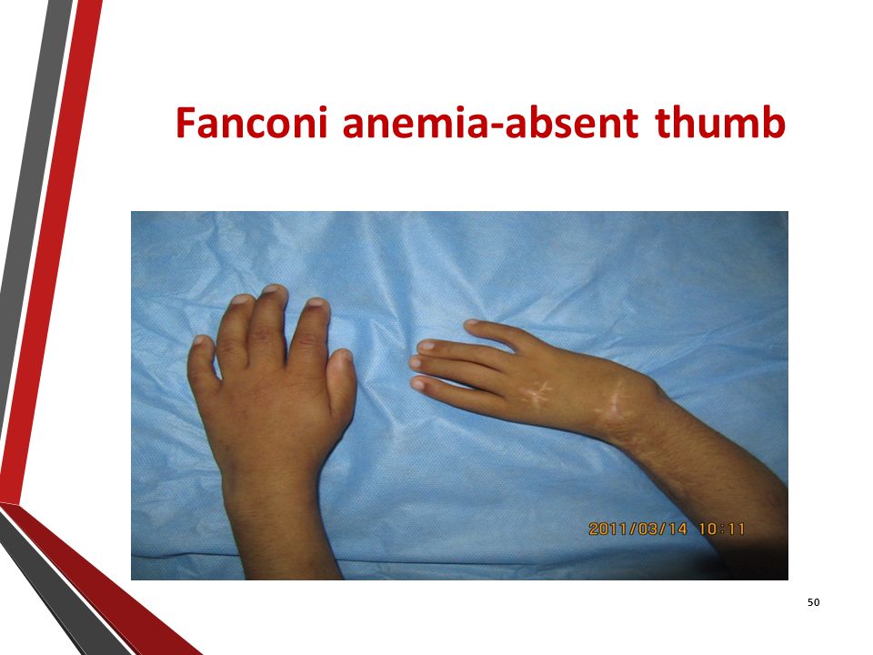 Getting the Right Anemia Treatment